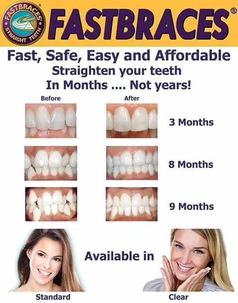 Fast braces results after 3 months, 8 months and 9 Months