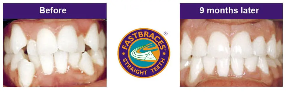 Fast braces before and after