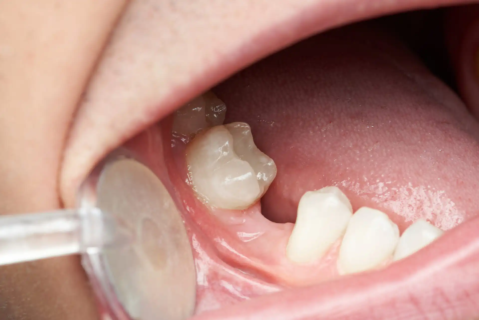 Close-up view of a gap from a missing tooth during a dental exam