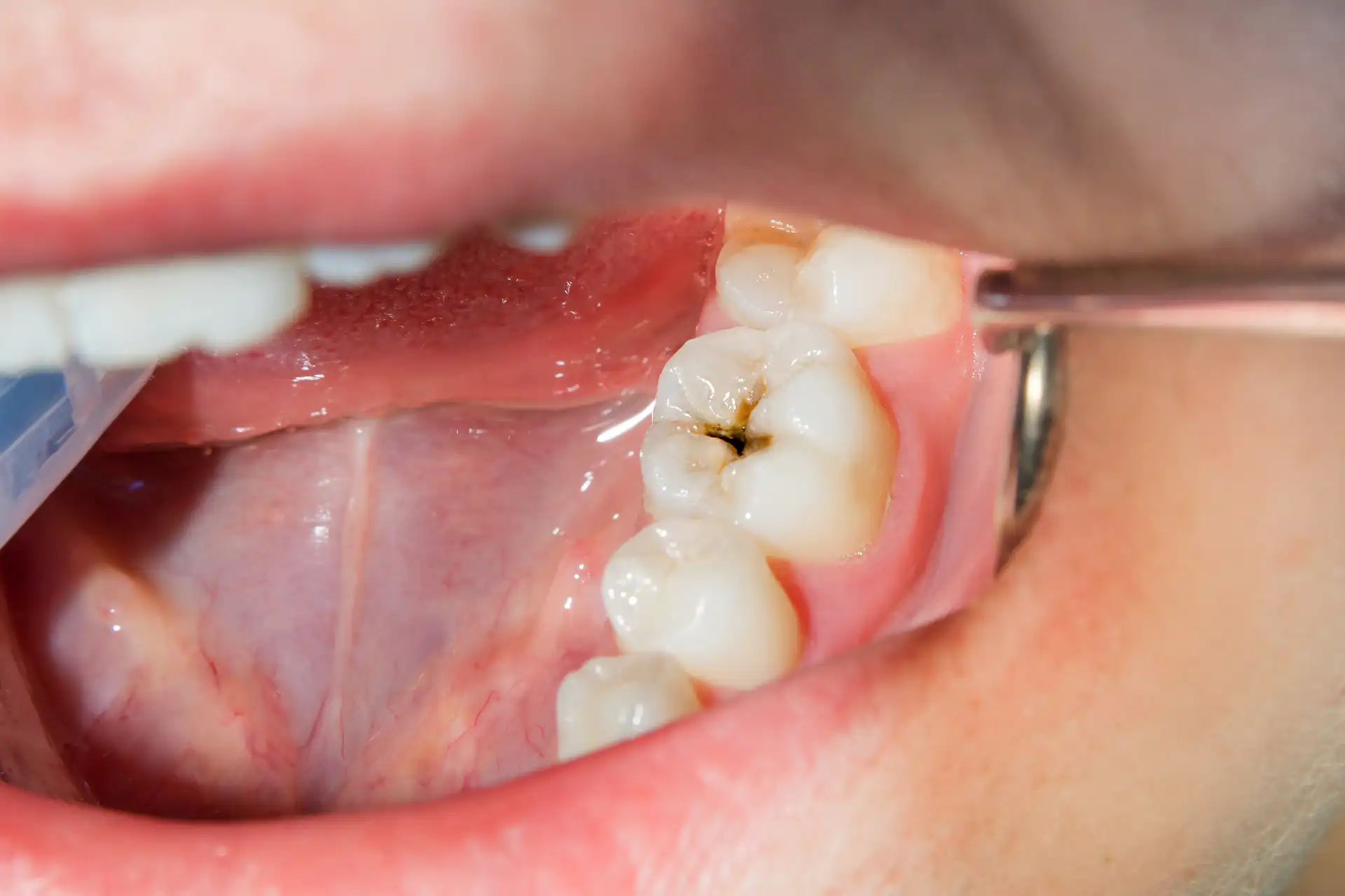 Close-up of a back molar with a dark spot on the chewing surface