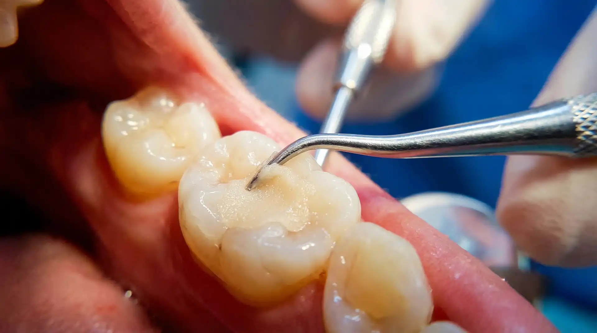 Dental instrument examining the chewing surface of a back molar