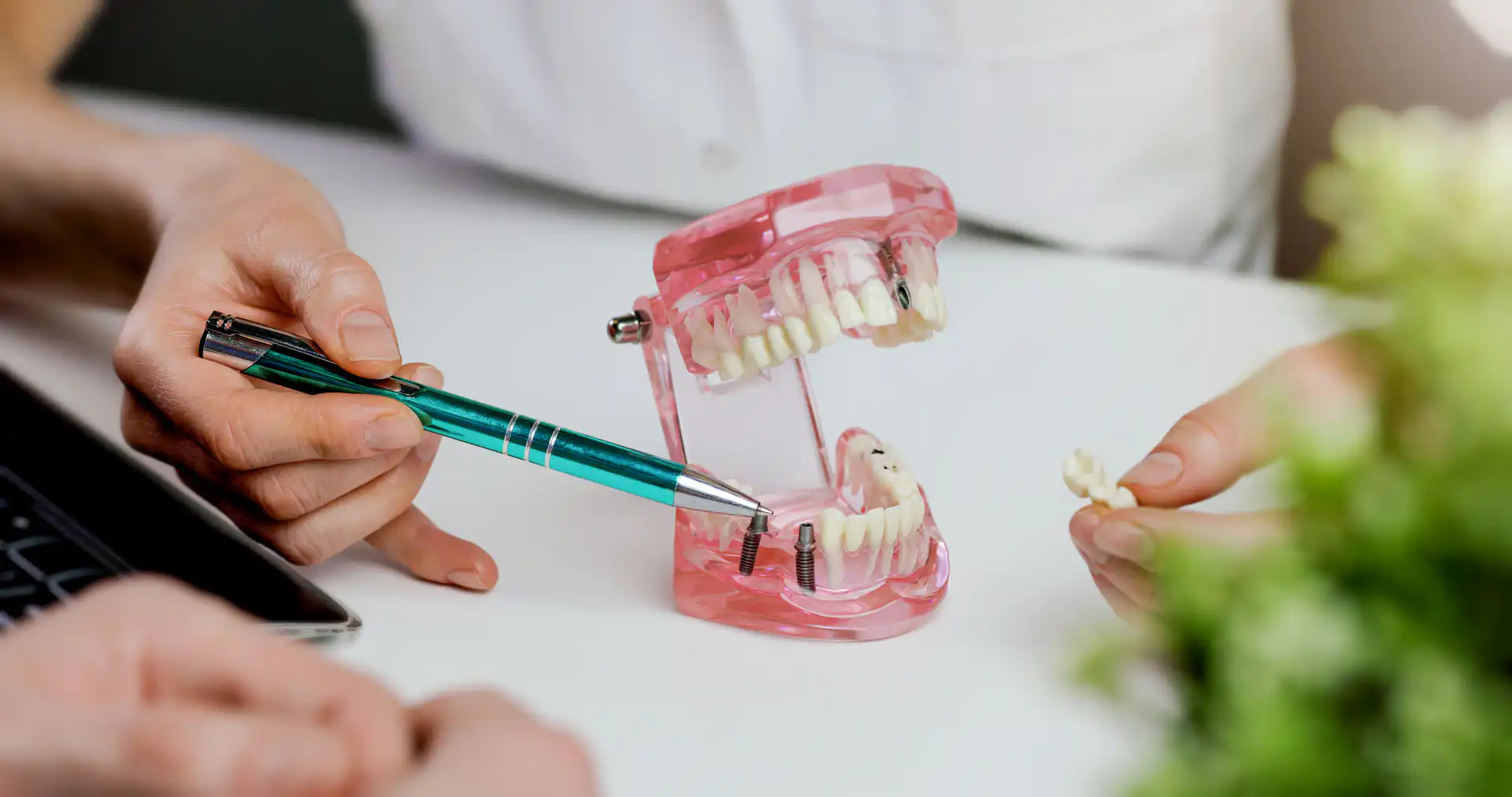 Dentist explaining dental bridge treatment with tooth model